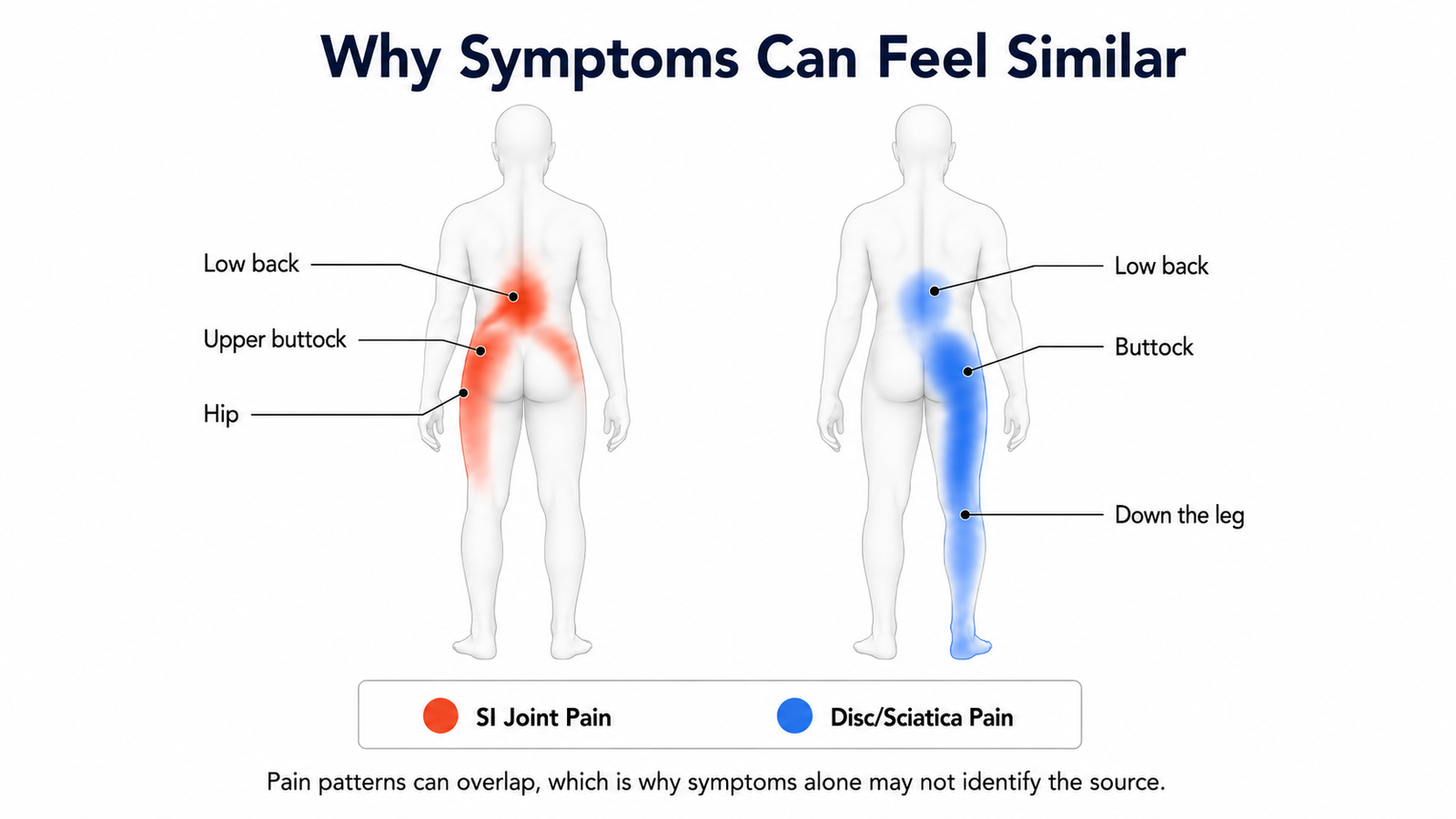 SI joint pain and sciatica pain patterns compared, showing overlapping low back, buttock, hip, and leg pain areas.